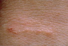 burrow scabies.jpeg