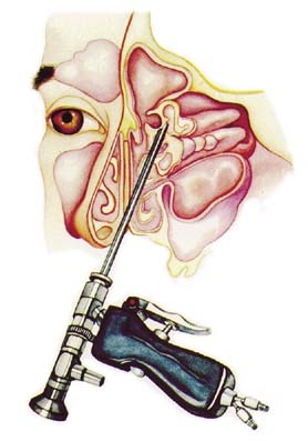 Sinus endoscopy1.jpg