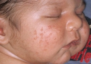 Baby-Acne-31.jpg