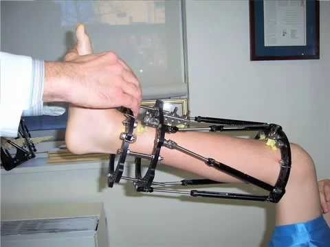 distraction-osteogenesis-limb.jpg