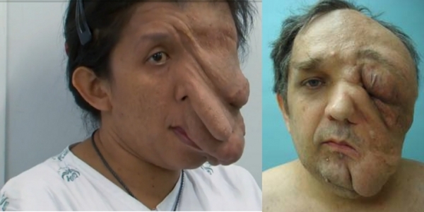 Giant-Facial-Tumor-Eats-Away-Half-of-Woman-Face-Exposes-Her-Brain-2.jpg