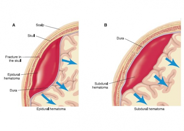Epidural&Subdural Hematoma(1) (1).jpg