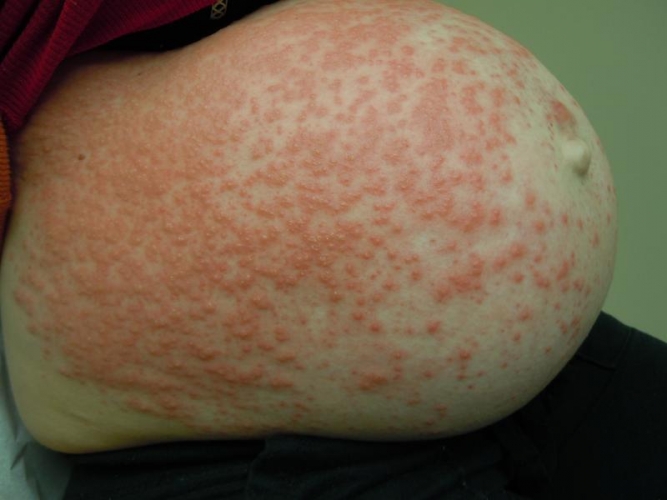 herpes-gestationis_12661402464eef8ec9ad284.jpg