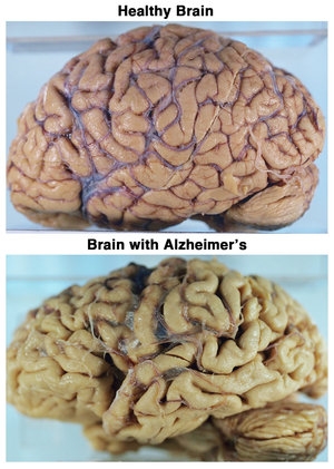 alzheimer.jpg