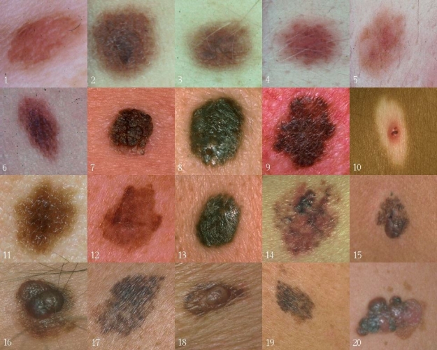 Twenty images of skin lesions. Images 1--6, 7--13, and 14--20 show atypical, benign, and malignant lesions, respectively..jpg